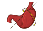 Stomach torsion, dog killer
